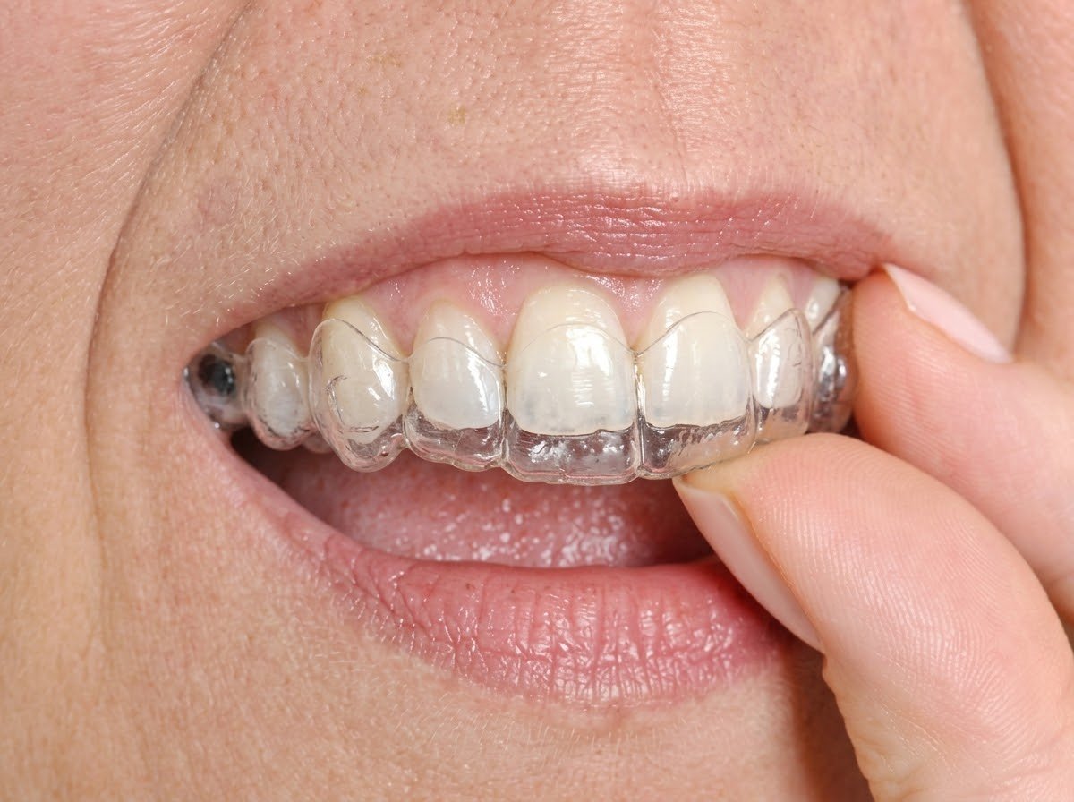 Alinhador transparente sendo encaixado sobre os dentes superiores com leve pressão dos dedos