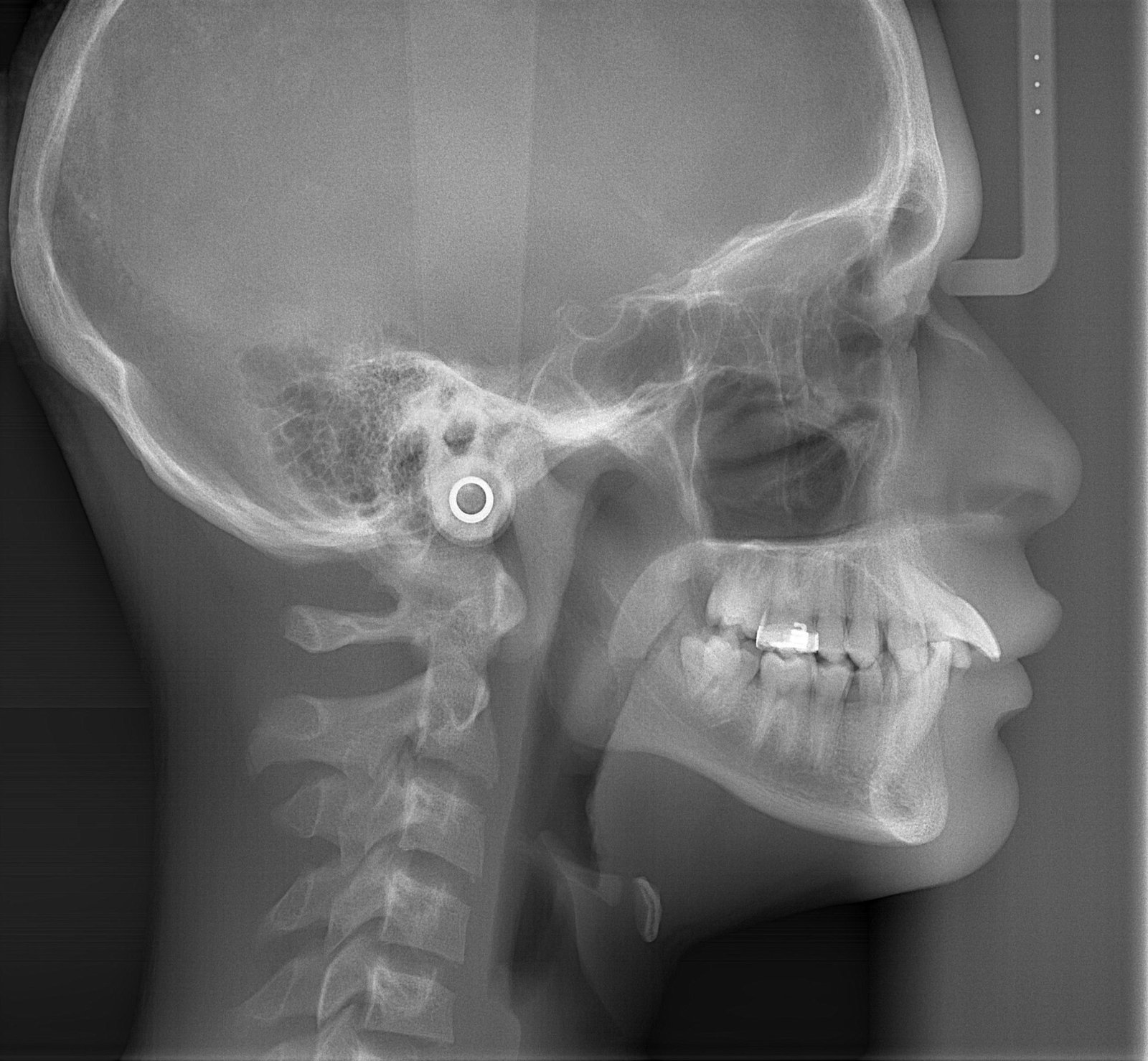 Telerradiografia lateral (cefalometria) para diagnóstico ortodôntico