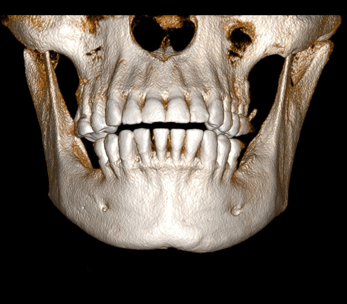 Tomografia de feixe cônico (CBCT) para diagnóstico ortodôntico